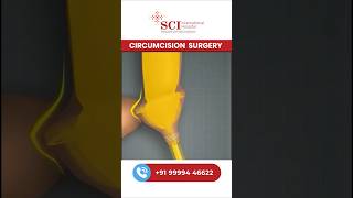 Pain-Free Circision? Stapler Technique Explained