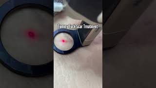 Tummy Tuck Scar Treatment, Post Surgery Scars, Acne Scar Treatment, Alma Hybrid Lasers