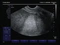 Ultrasound Video (13/14 weeks)