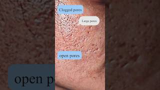 Try This For 6 Daysopen Pores Treatmentමහන සදර වලට සතකරමහන වලවල