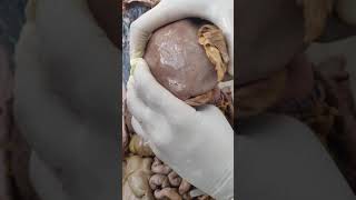 Horizontal Peritoneal Tracing Above The Epiploic Foramen