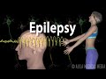 Epilepsy: Types of seizures, Symptoms, Pathophysiology, Causes and Treatments, Animation.