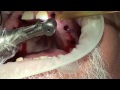 cirugía dental