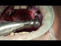 cirugía dental