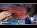 Live stream - ex lap with intestinal biopsies in a dog