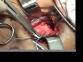 clavicular