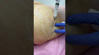 Sculptra With Dr. Tsay