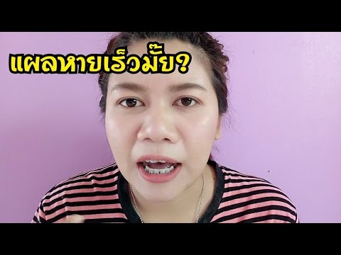หลังถอนฟัน ดูแลยังไง แผลหายเร็วมั๊ย?