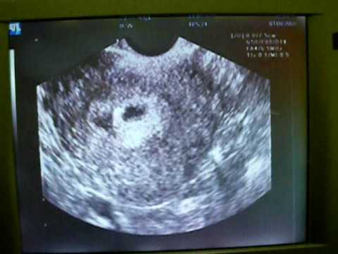 first ultrasound 6 weeks pregnant surrogacy #2 - YouTube