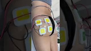 Trusculpt Flex For A Hot Girl Summer Booty