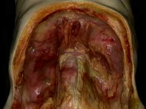 2 Abdominal cavity, peritoneum - YouTube