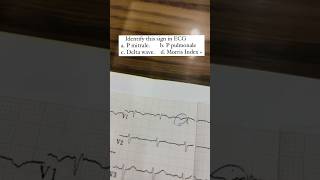 Ecg Sign Dr Arvind Kumar