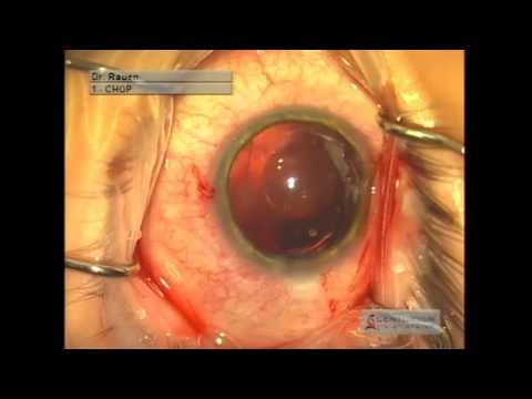 Wolfe Eye Clinic West Des Moines Iowa Icl Surgery Lasik Wolfe Eye Clinic West Des Moines Iowa Icl Surgery Lasik Alternative