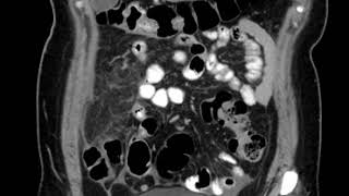 Omental Infarction B Ahuja At Et Al 2017 Book Essential Radiology