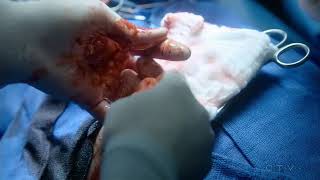 Code Black Ep- 17 Part- 1012 Brody Critical Scene Code Black Cameron Boyce Critical Scene