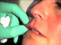 RIEMPIMENTO DELLE LABBRA con FILLER di ACIDO IALURONICO (Napoli)