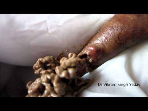 Sebaceous Cyst &Keratin