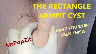 Have You Ever Seen A Rectangular Cyst? Deep Cavernous Pocket In The Armpit Removed. Axilla Pop.