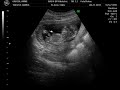 14 week ultrasound. It's a Boy!
