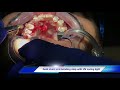 How to do surgical exposure of impacted upper right canine on a 22 years old male