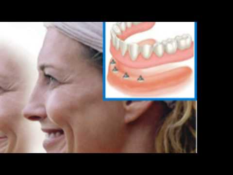 Dental Implant Dentures 12-21 -s