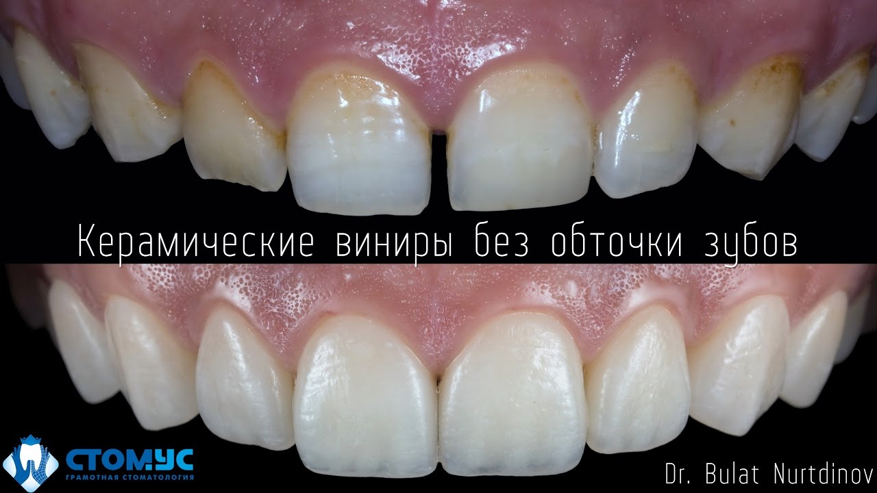 Что такое виниры без обточки зуба Что такое виниры без обточки зуба