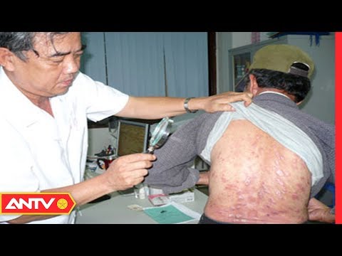 Ẩn họa tiềm tàng từ bệnh Zona thần kinh và cách chữa trị | SKMN | ANTV