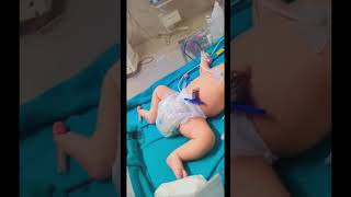 Newborn Weighing 5Kg Big Baby Macrosomia
