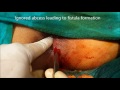PERIANAL ABSCESS