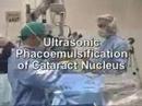 Modern Cataract Surgery