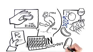 The Ring Birth Control 101