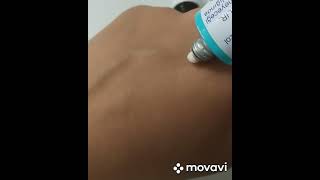 Expigment Cream Melasma Chloasma Hyperpigmentation Treatment