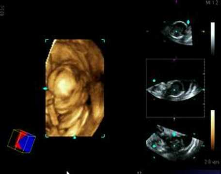 3d ultrasound pictures of twins. Lillian 3D Ultrasound 5 months; Lillian 3D Ultrasound 5 months. lewis82. Apr 13, 01:27 PM 3d ultrasound pictures of twins. 3d ultrasound pictures of twins. Lillian 3D Ultrasound 5 months; Lillian 3D Ultrasound 5 months. lewis82. Apr 13, 01:27 PM