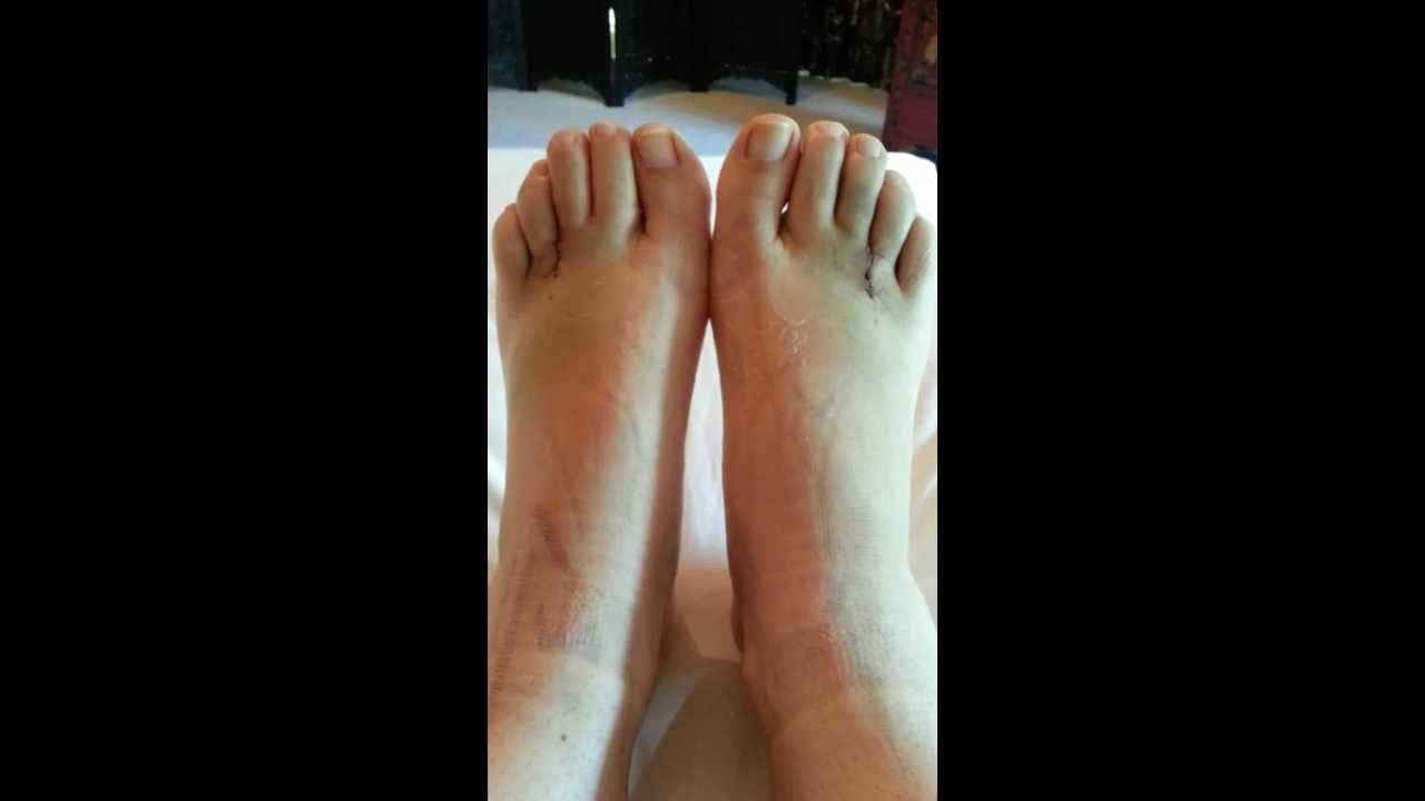 intermetatarsal neuroma