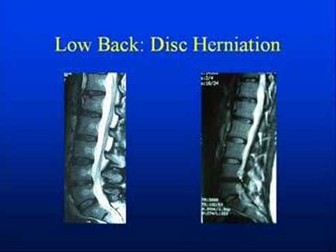 Low Back Anatomy with pinched nerves, disc ruptures & pain - YouTube