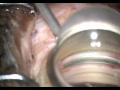 case 5 phaco trabectmoe fel tight incision causing constant focus changes part 2