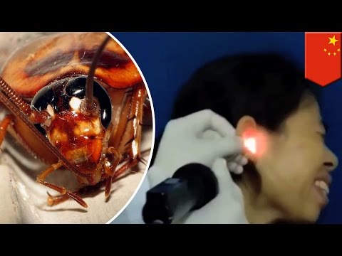 Cockroach in ear: video of Chinese woman have having live insect pulled from ear - TomoNews