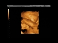 Baby Johnson 4D Ultrasound video