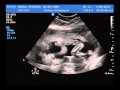 Mina Baby (20 weeks)
