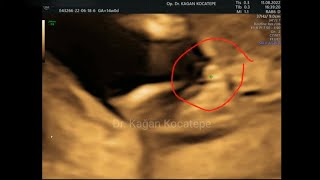 14 haftalık kız bebek, doğru tanı için bacak arasında labium majuslar ve klitoris mutlaka görülmeli.