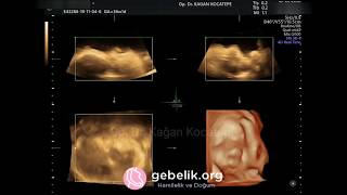 36 HAFTALIK (8.5 AYLIK) GEBELİKTE BEBEĞİN YÜZÜ NASIL GÖRÜNÜR? (HD 4 BOYUTLU)