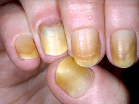El ungüento graso a la psoriasis