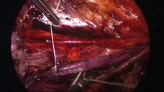 Cyclist Laparoscopic Left Iliac Endofibrosis Surgery
