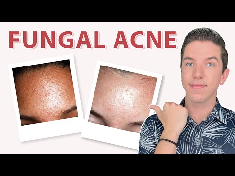 Little Bumps on Your Face & How to Get Rid of Them - YouTube