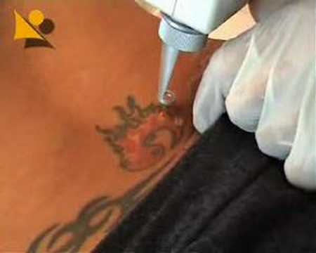 practical tattoo removal. You can see more on the website http://www.amjolianne.com practical tattoo removal. You can see more on the website http://www.amjolianne.com