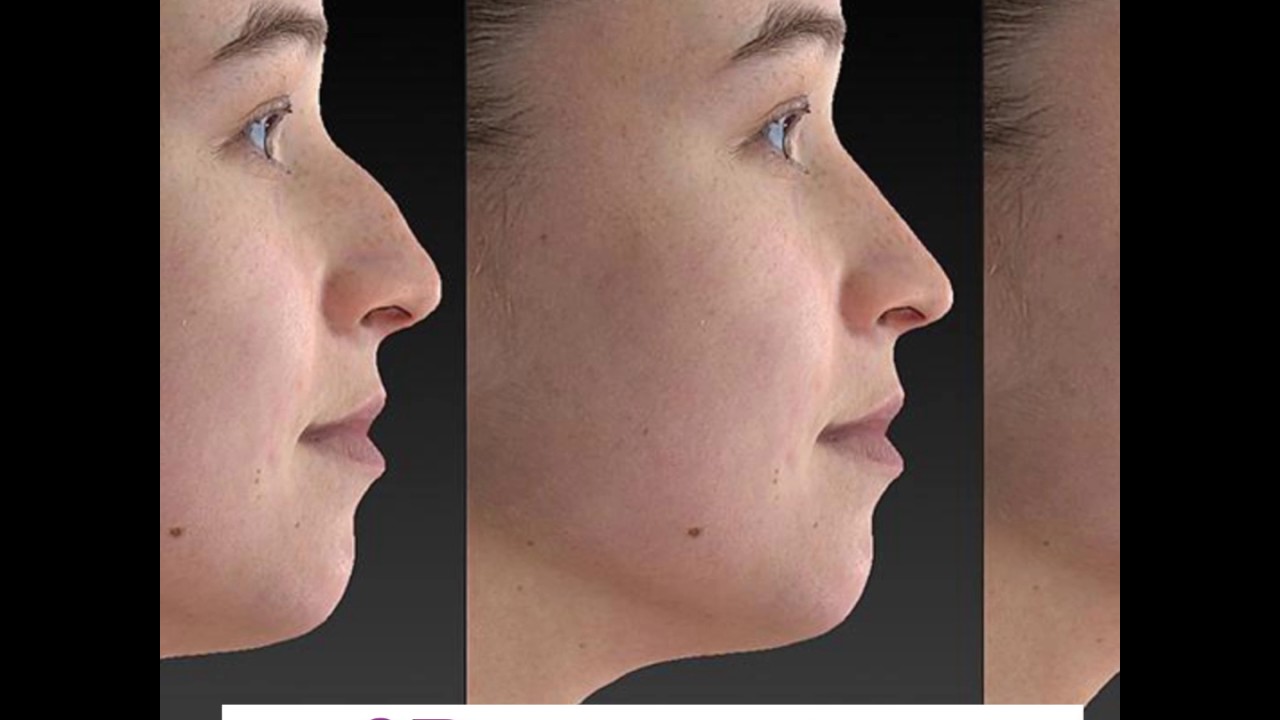 Facial sculpting surgery