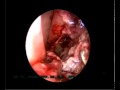 Maggots in Nose