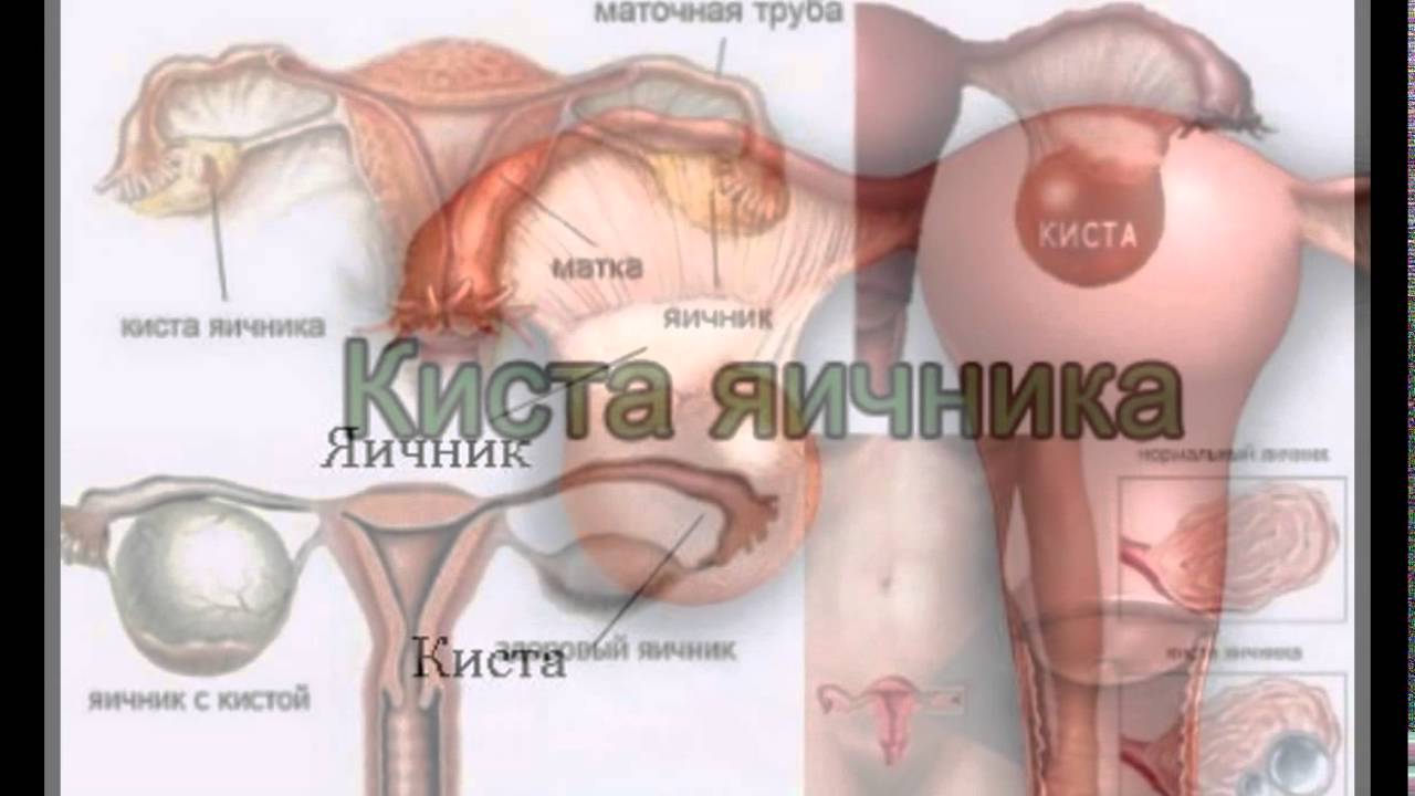 Киста на яичнике лечение в домашних условиях 808