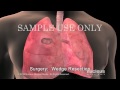 Lung Cancer Treatment