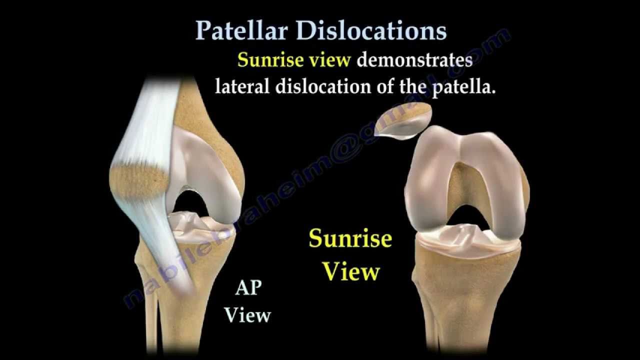 Patellar Dislocations - Everything You Need To Know - Dr. Nabil